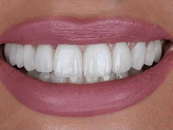 After dental implants treatment